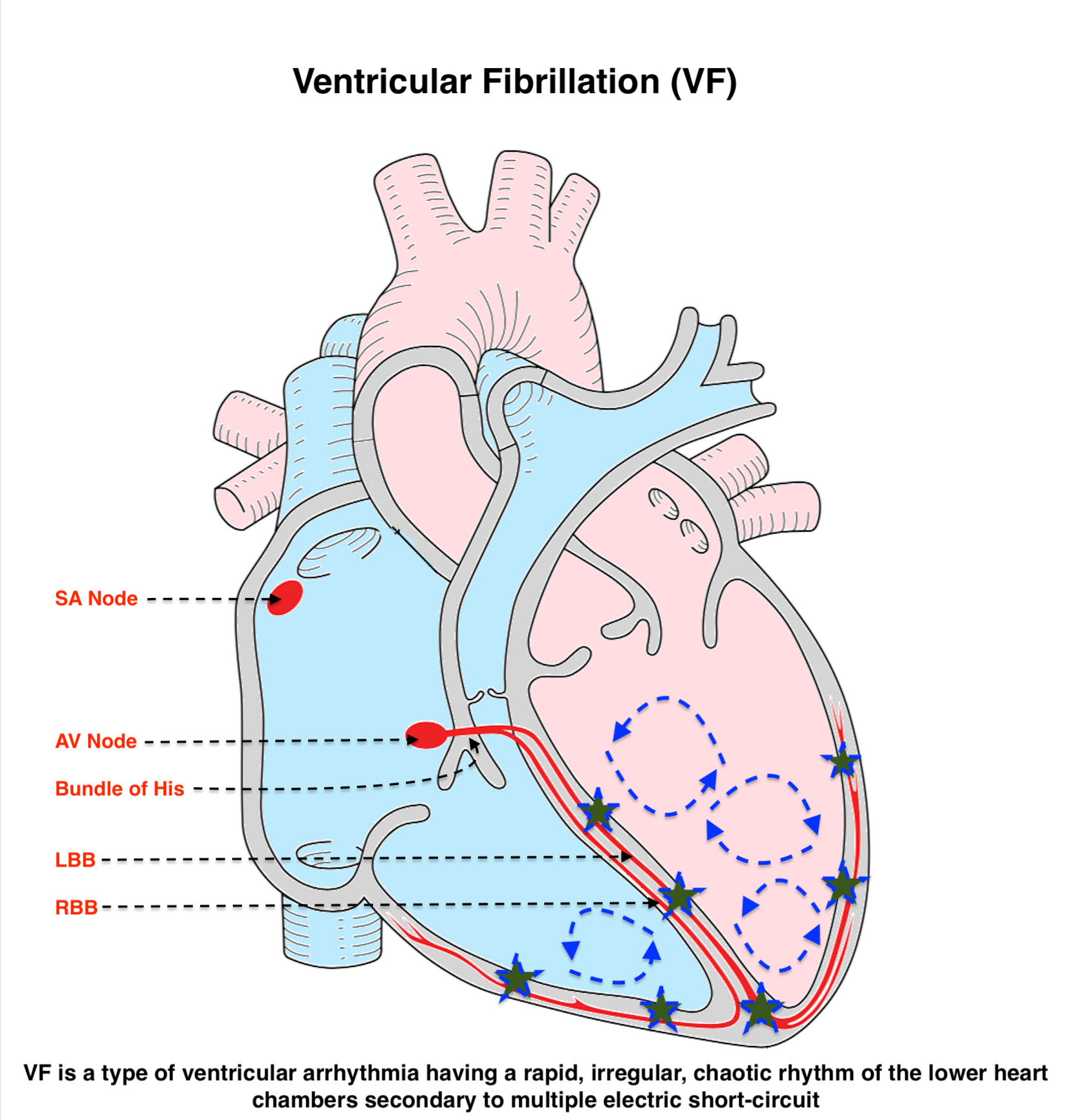 Ventricular Fibrillation (VF)