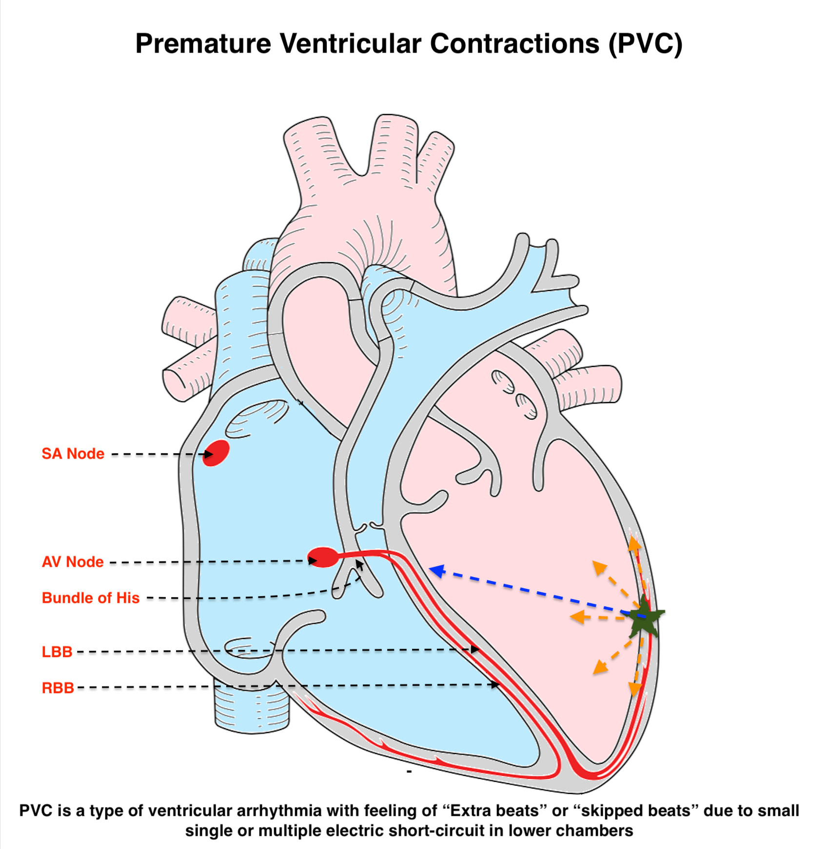 Premature Ventricular Contractions (PVC)