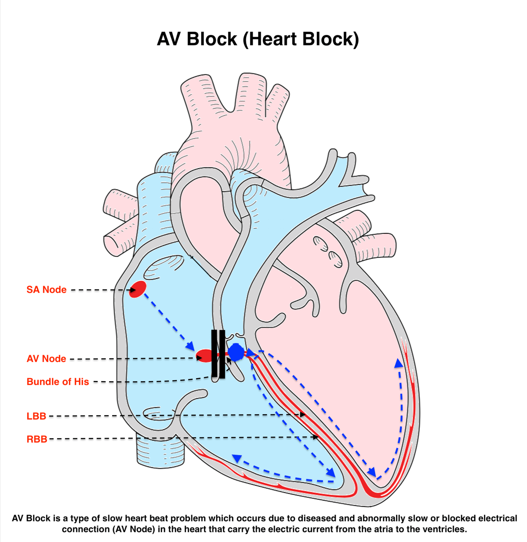 AV Block