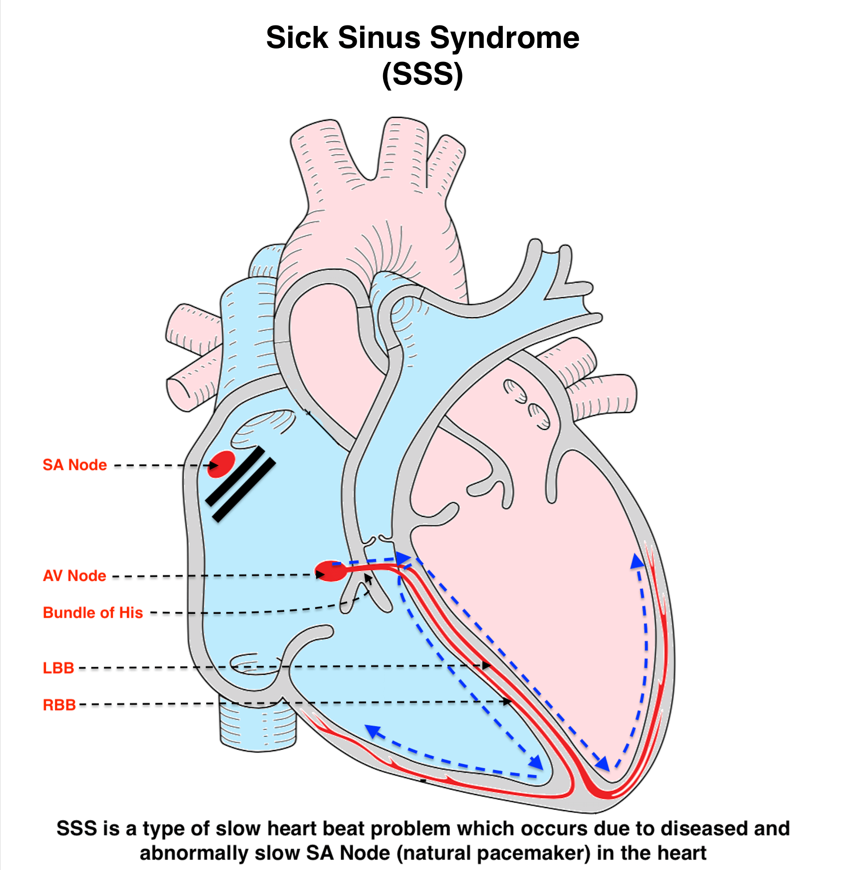 SICK SINUS SYNDROME