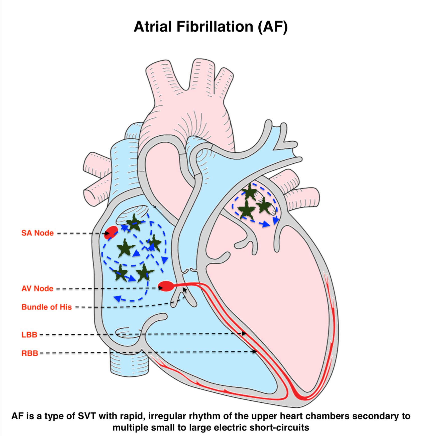 Atrial Fibrillation (AF)