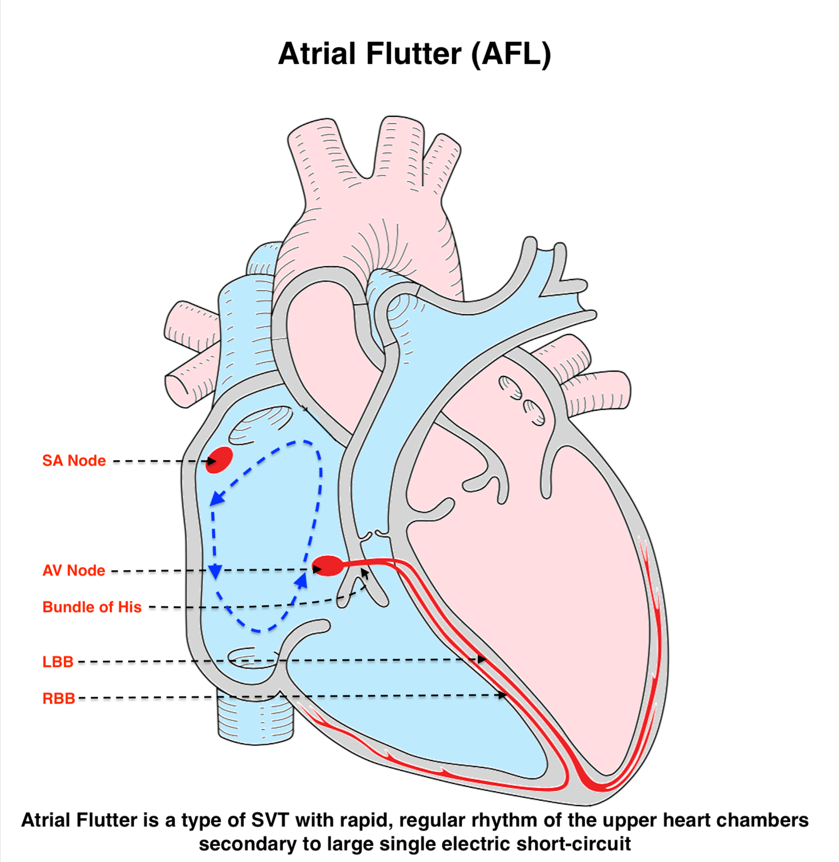 Atrial Flutter (AFL)