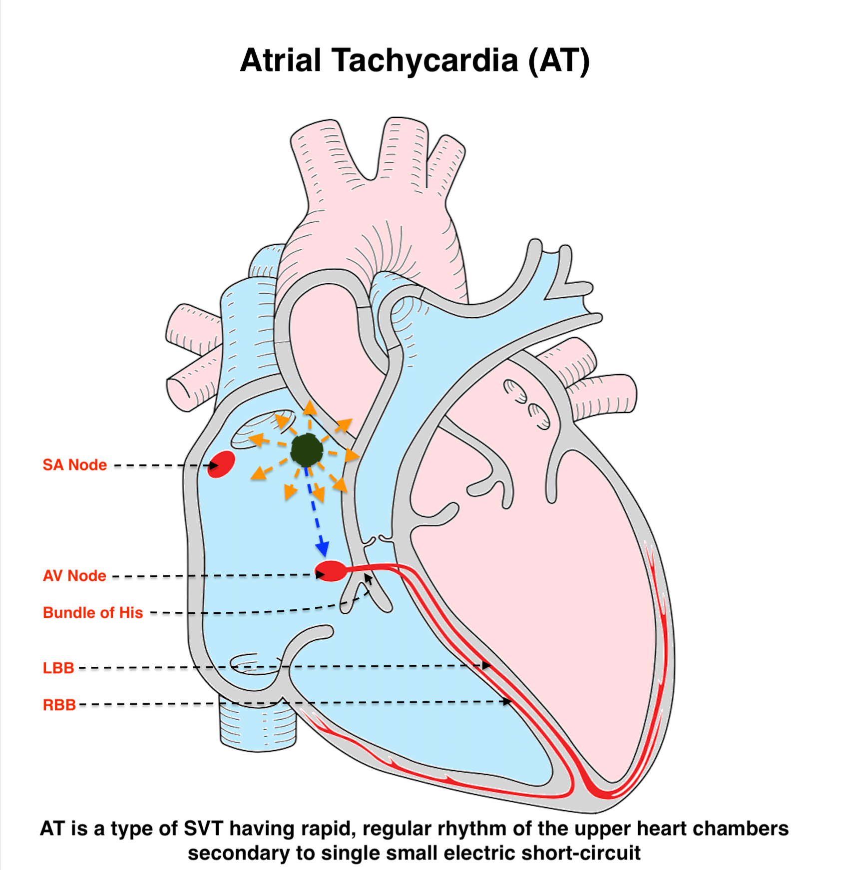 Atrial Tachycardia (AT)