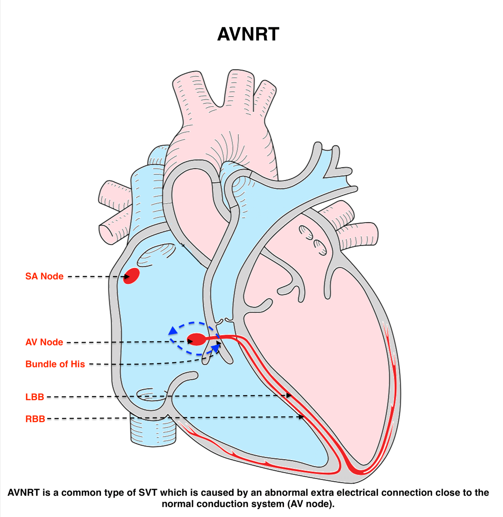 Atrioventricular Nodal Re-entrant Tachycardia (AVNRT)