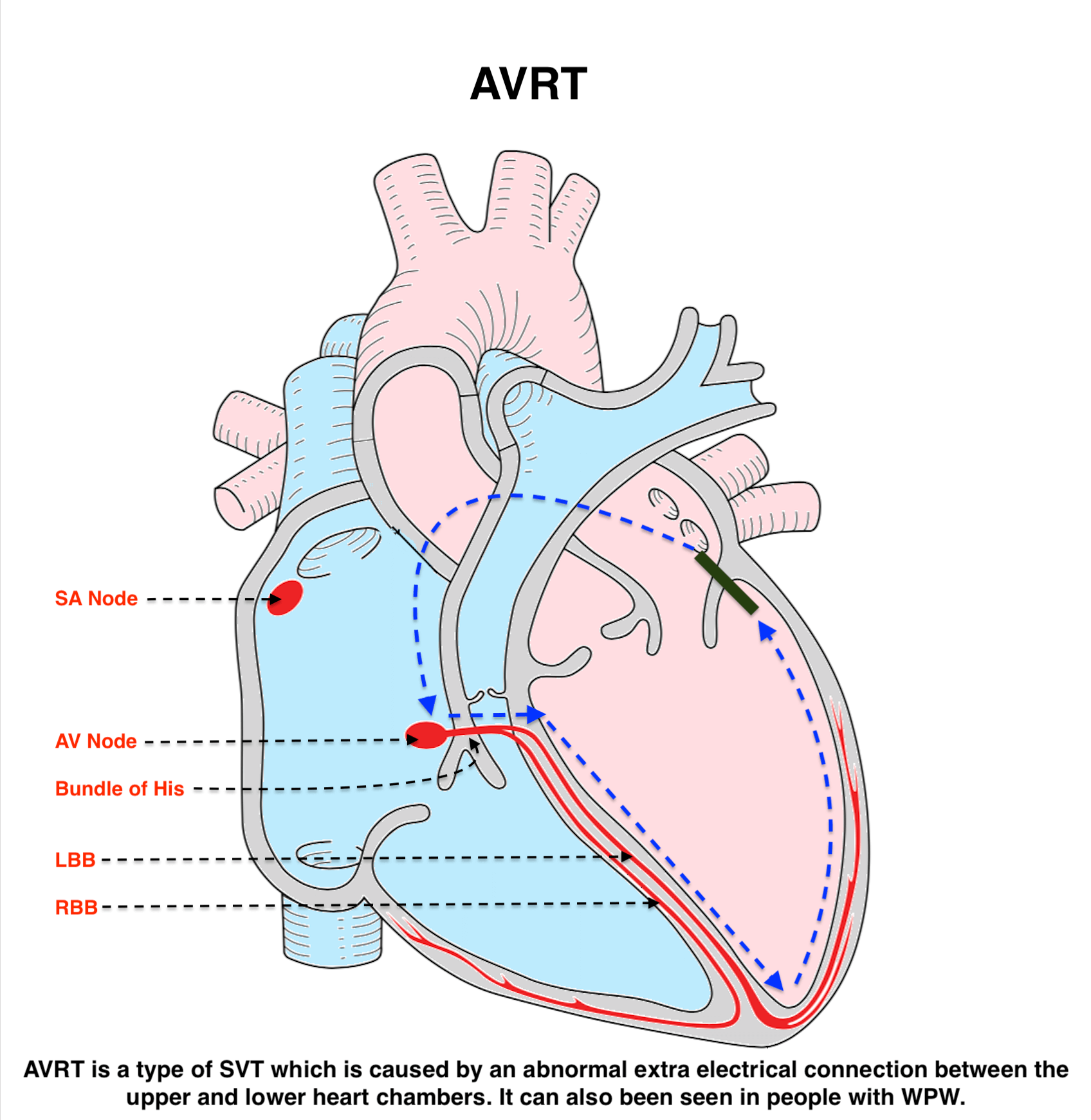 Atrioventricular Reciprocating Tachycardia (AVRT)