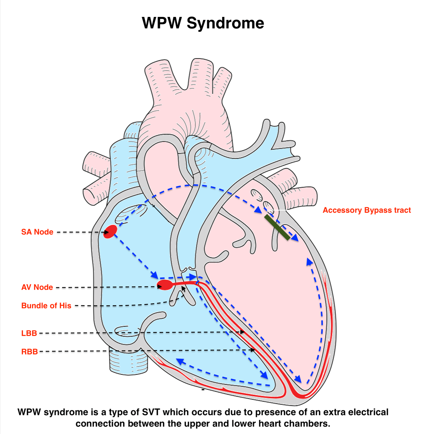 Wolff-Parkinson-White Syndrome (WPW)