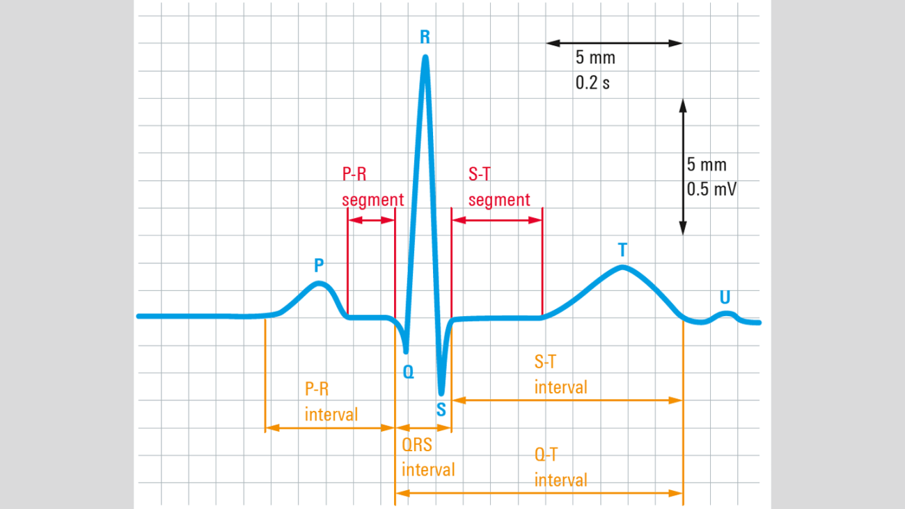 Electrocardiogram (ECG)