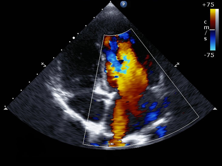 Echocardiogram (Ultrasonography of Heart)