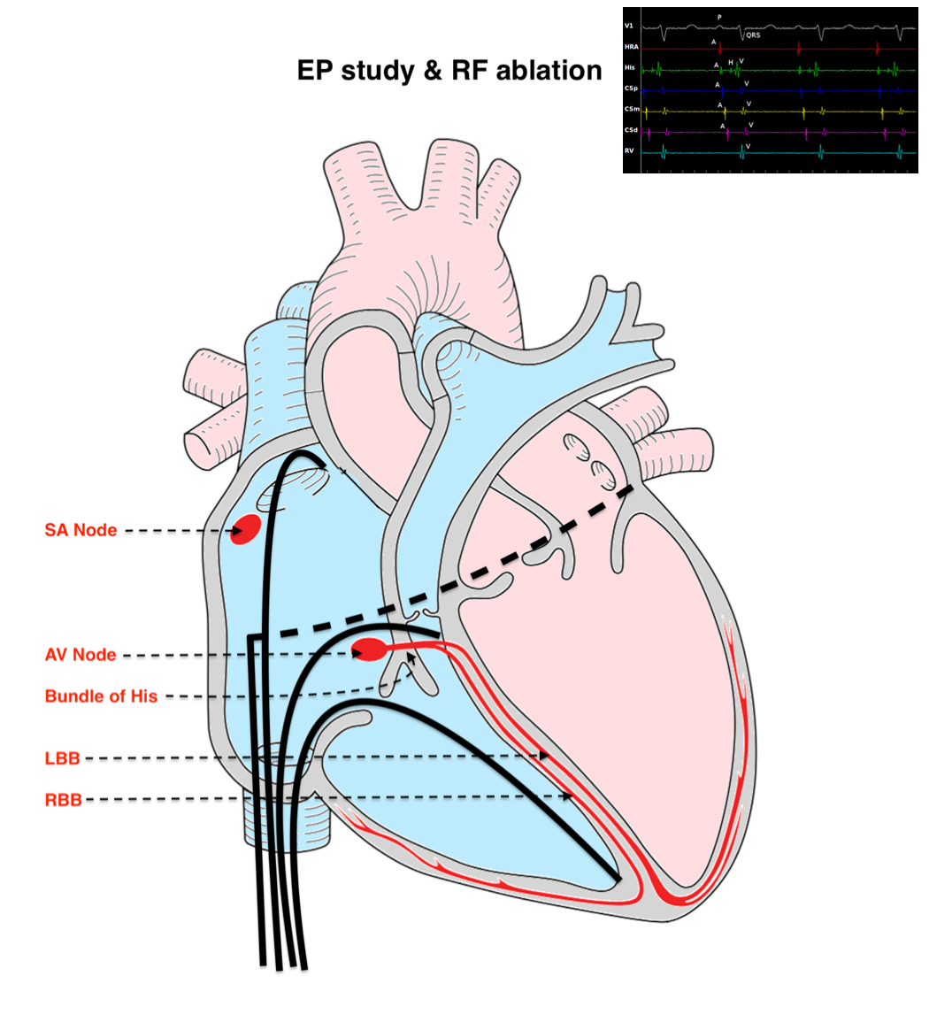 RF Ablation