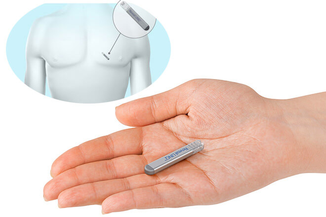 Implantable Loop Recorder