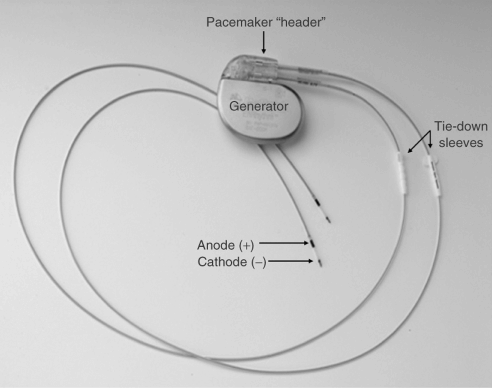 Pacemaker Pulse Generator With Leads