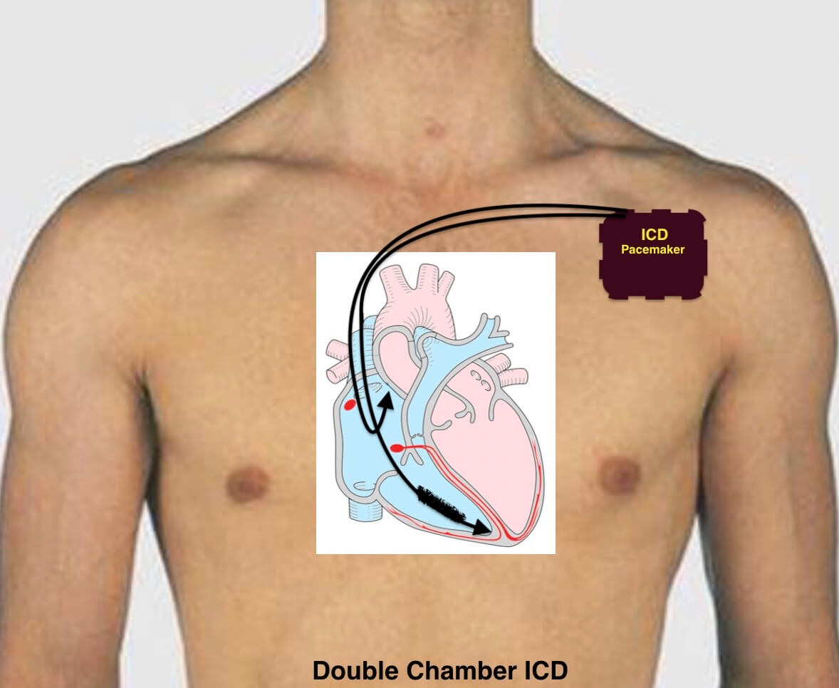 Implantable Cardioverter defibrillator