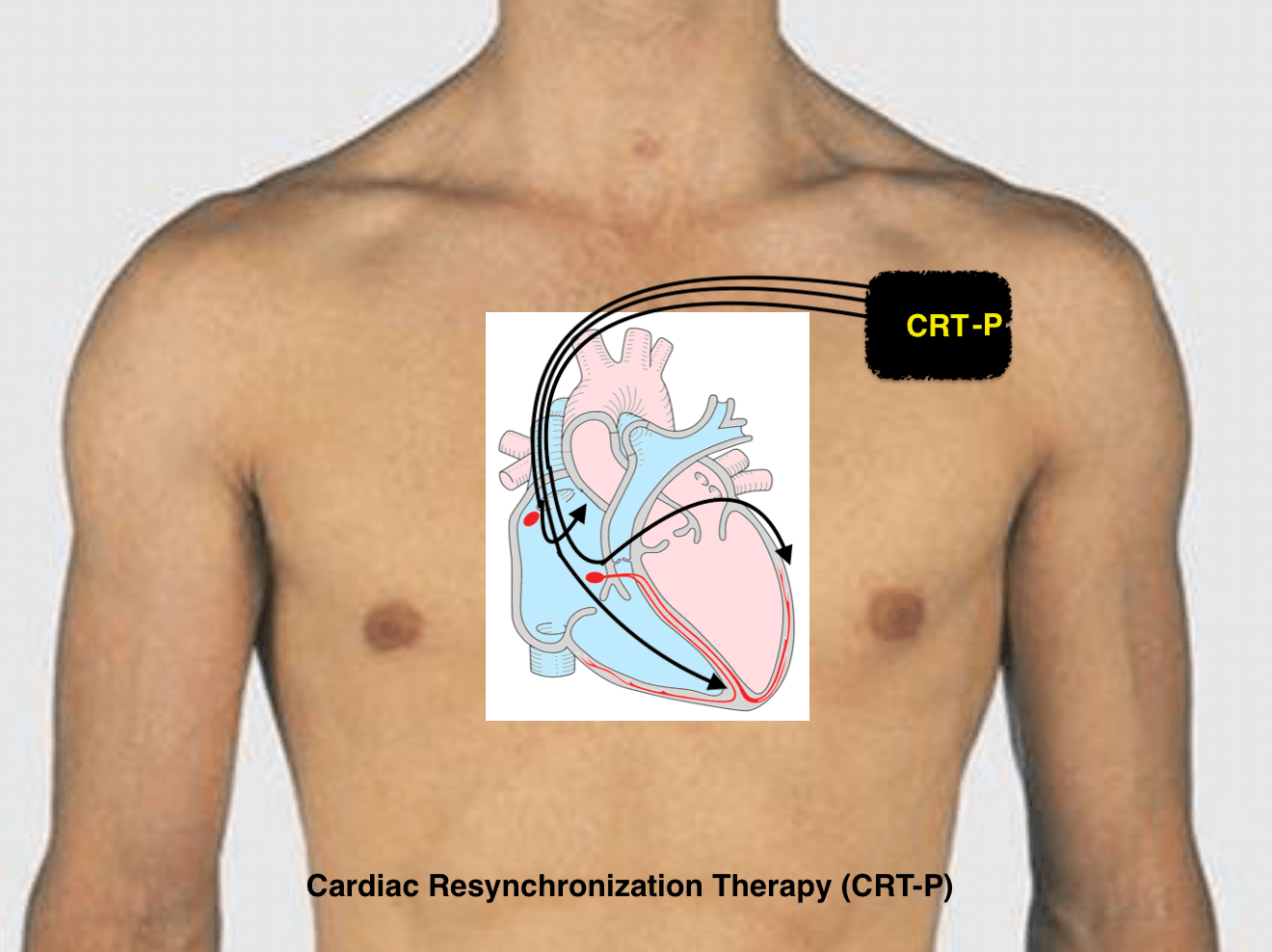 Implantable Cardioverter defibrillator